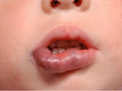Puffy χείλος: τέσσερις αιτίες αδιαθεσίας